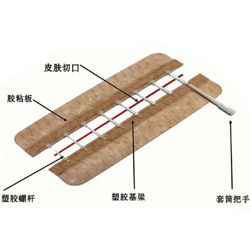 一次性使用免缝闭合器 ZHQ-175